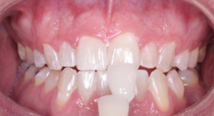 Teeth with a shade guide. Comparison of tooth color to shade tab for whitening procedure.