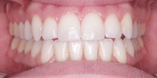 Close-up of a person's teeth, showing aligned, white teeth and pink gums.