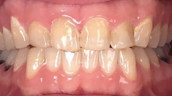 Close-up of a person's teeth. Upper and lower teeth are visible with slight discoloration. Gums appear healthy.