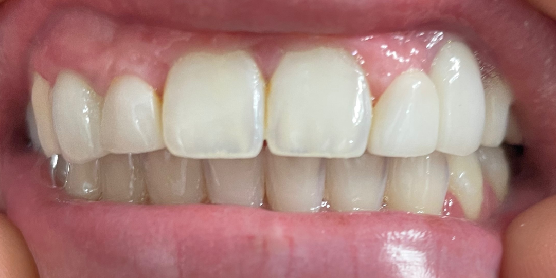 Close-up of a person's teeth. Bright, white teeth are visible, set in a pink gumline.