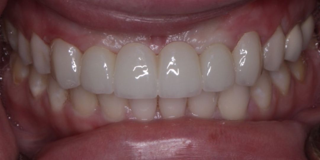 Close-up of a person's teeth. Bright, white teeth are visible, set in a healthy mouth.