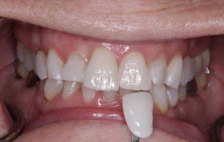 Close-up of teeth with a shade guide. Teeth are white and slightly crooked. A guide is held up to the teeth.