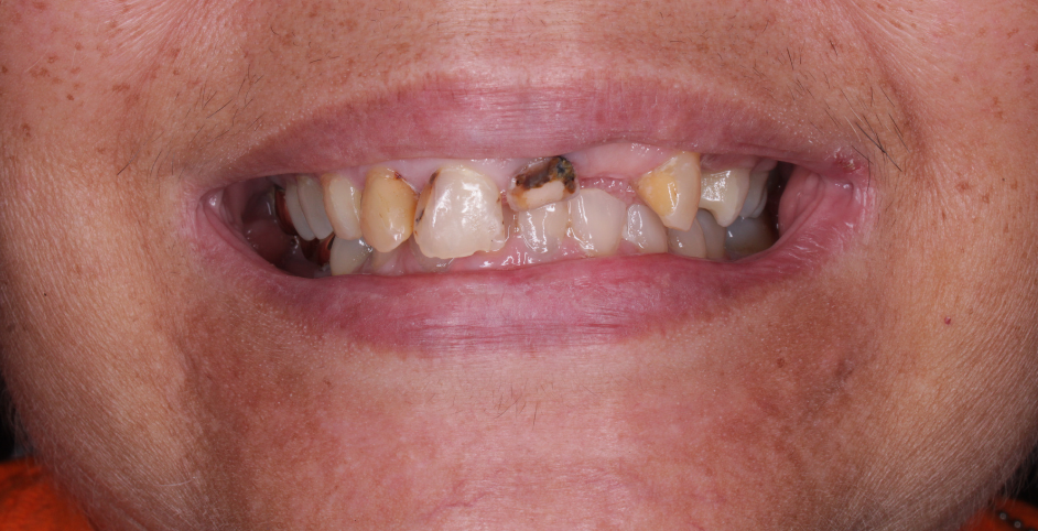 Mouth with multiple cavities and discolored teeth, showing poor dental health.