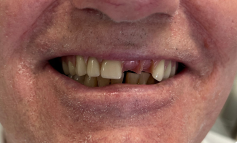 Close-up of a person's mouth with a missing front tooth and visible teeth.