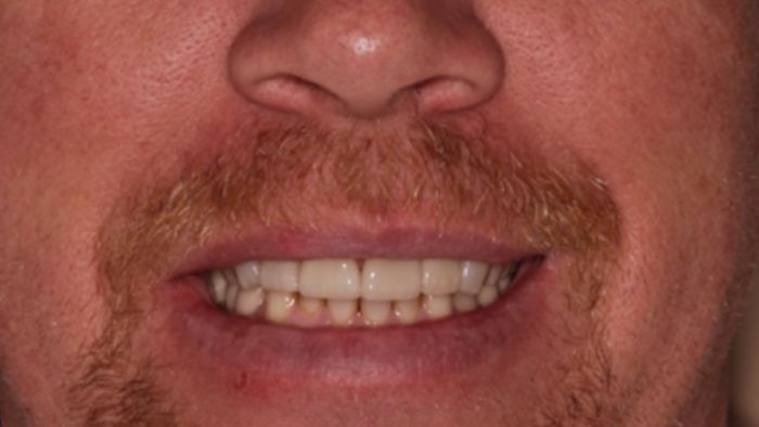 Close-up of a person's smiling mouth and nose; shows teeth, mustache, and reddish facial skin.