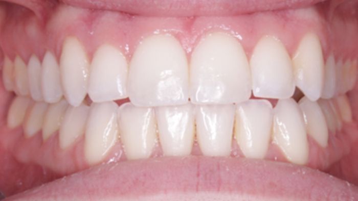 Close-up view of a person's teeth, showing a complete, straight smile. Teeth are white and the gums are pink.