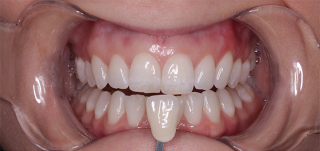 Close-up of teeth with a shade guide. The teeth are white, and a clear cheek retractor is in place.