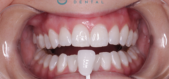Dental teeth whitening comparison with shade guide. The teeth are white with healthy gums.