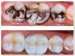 Top: Mouth with teeth, old silver fillings. Bottom: Mouth with teeth, tooth-colored fillings.