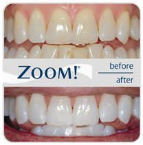 Teeth whitening before and after: stained teeth become bright white after Zoom! treatment.