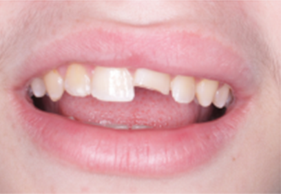 Close-up of a person's mouth with a chipped front tooth. The person's lips are slightly open, revealing their tongue.
