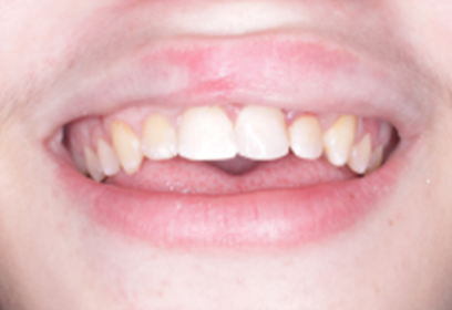 Close-up of a person's open mouth, showing teeth. Teeth have a slight yellow tint, and the mouth is slightly open.