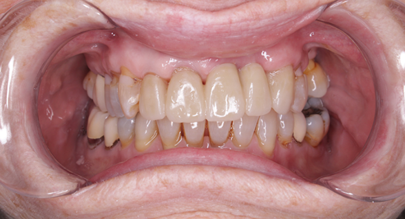 Mouth with teeth exposed and dental retractor in place; teeth appear yellowed, with some staining and gaps visible.