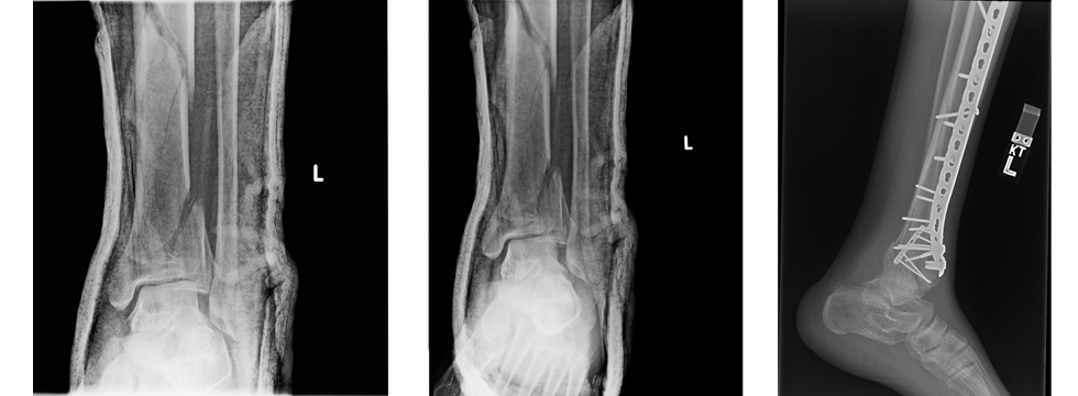 Ankle Fracture Treatment
