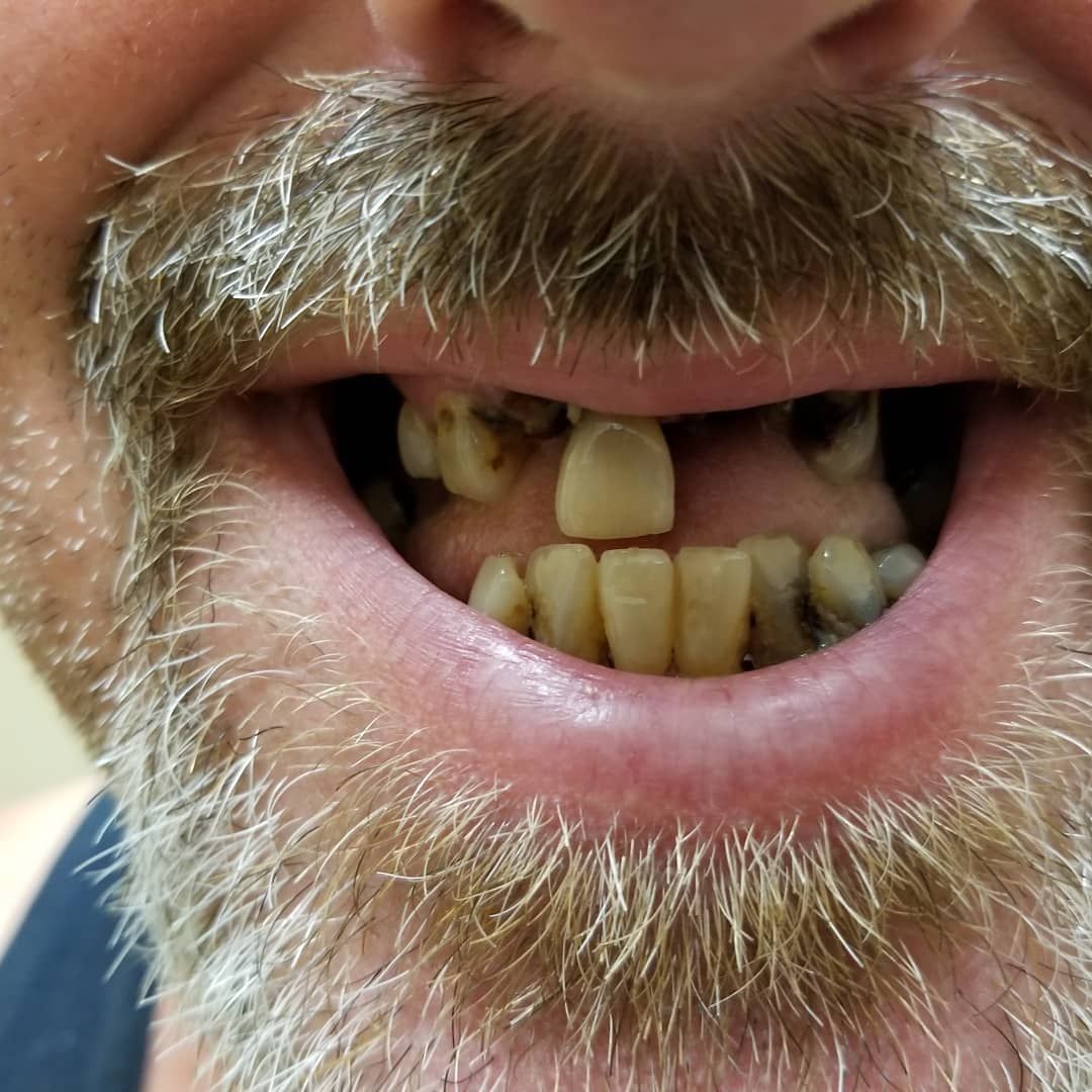 a man with a missing teeth is smiling.