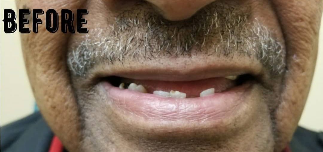 a close up of a man 's mouth with missing teeth .