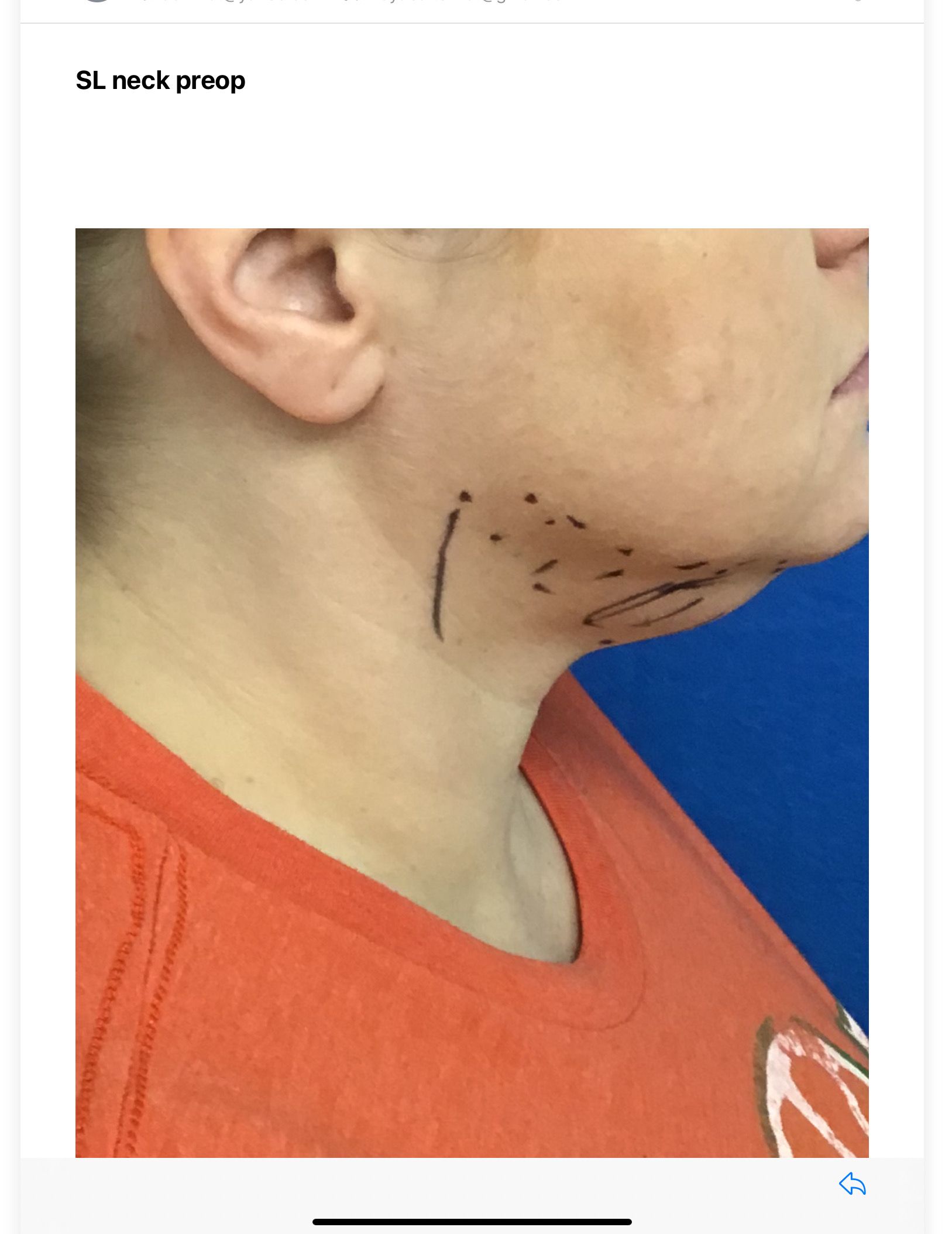 A picture of a woman 's neck with lines drawn on it