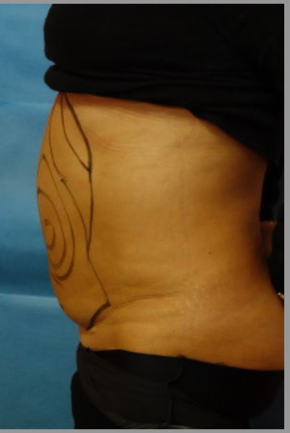 A woman 's stomach with a line drawn on it