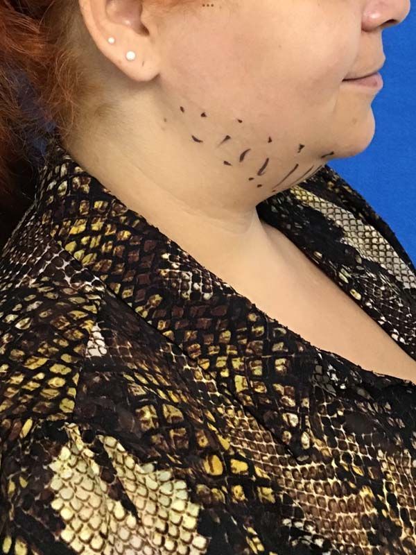 A woman with a snake print shirt has markings on her neck