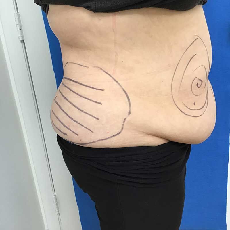 A woman 's stomach has lines drawn on it