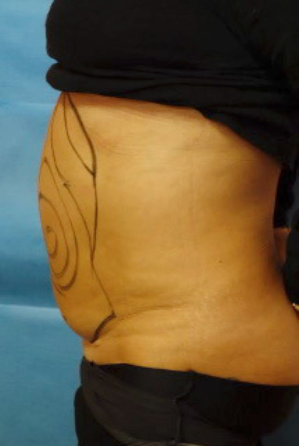 A woman's stomach with a line drawn on it