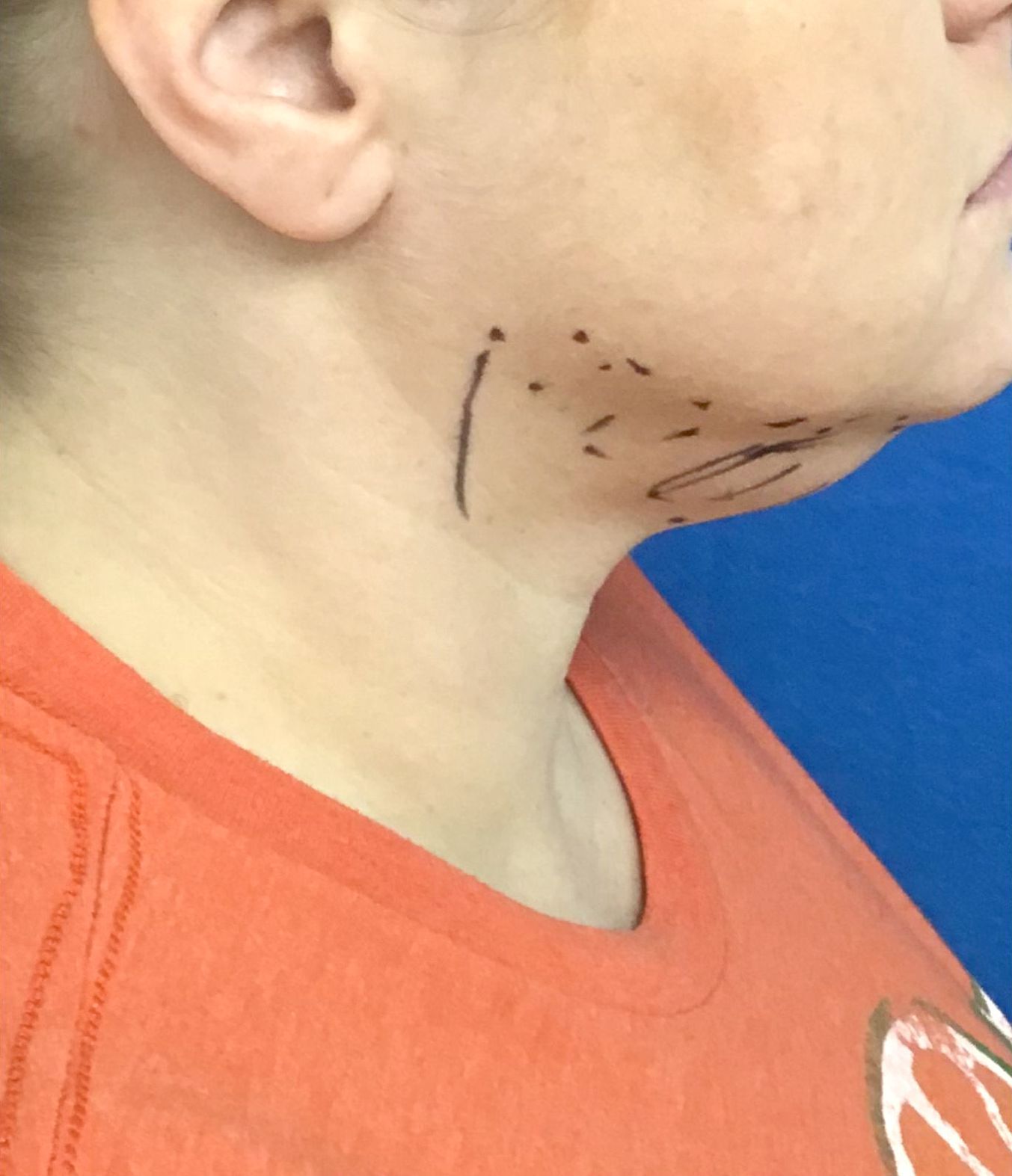 A picture of a woman's neck with lines drawn on it