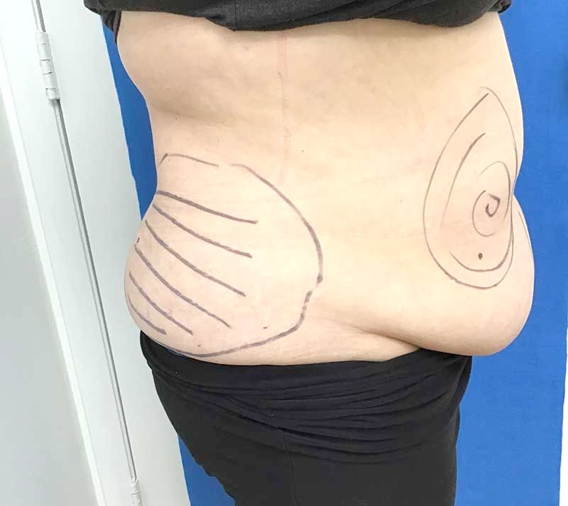 A woman's stomach has lines drawn on it