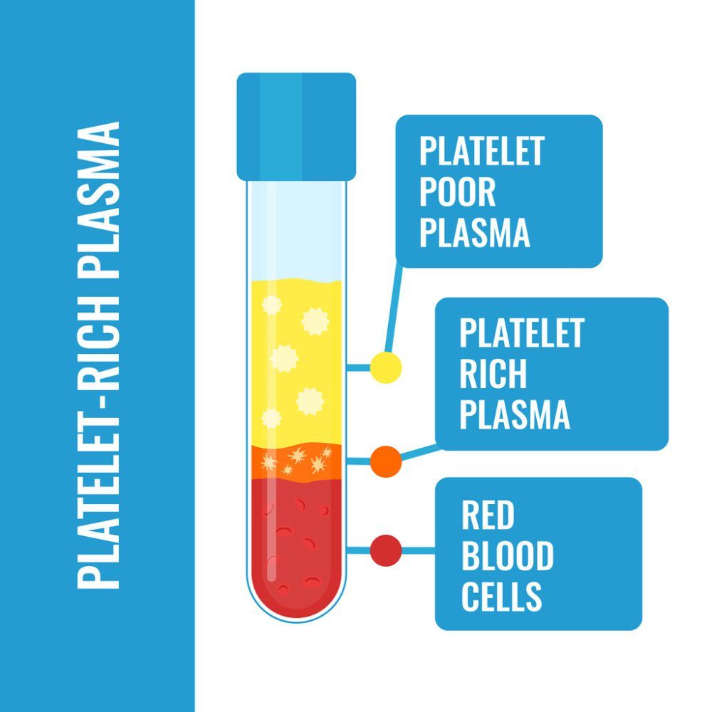 Platelet-Ruch Plasma