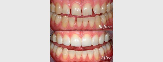 Teeth whitening before and after bonding