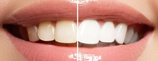 Teeth, whitening