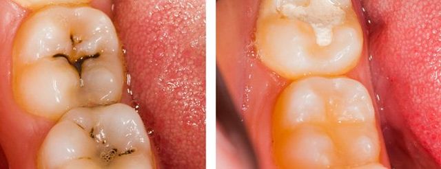 Finding the Best Material for Filling a Tooth Cavity - West
