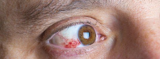 Eye disease