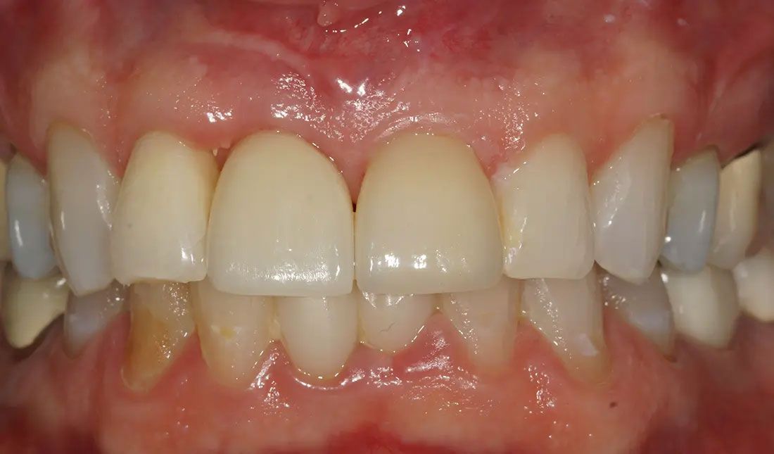 Implant and Veneer - After