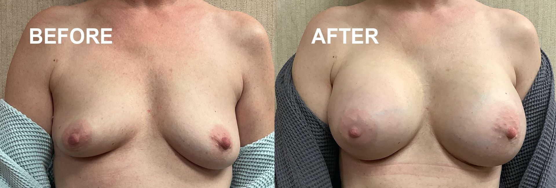 Before and after photo of breast augmentation