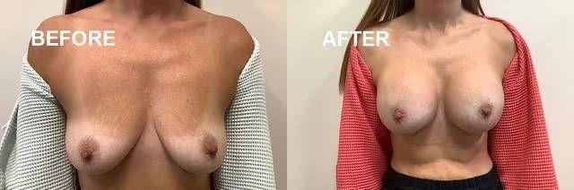 Breast Augmentation