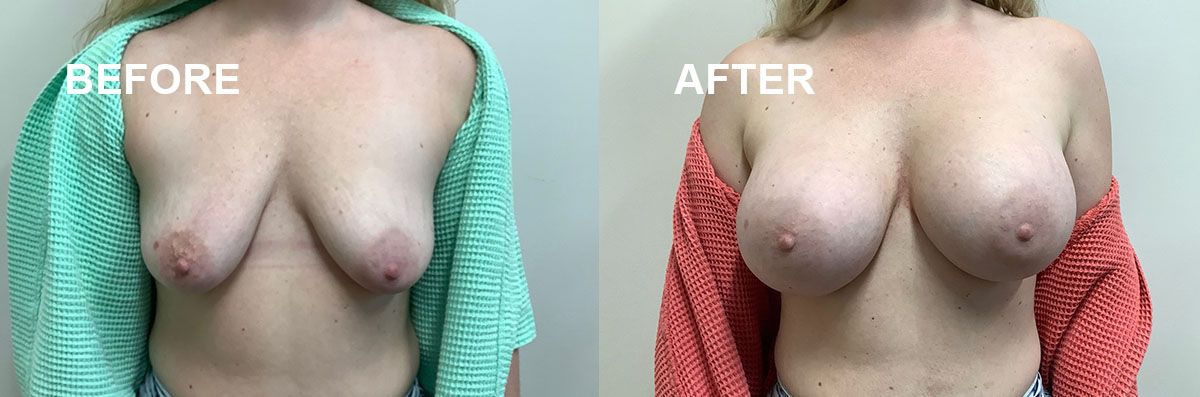 Breast augmentation before and after