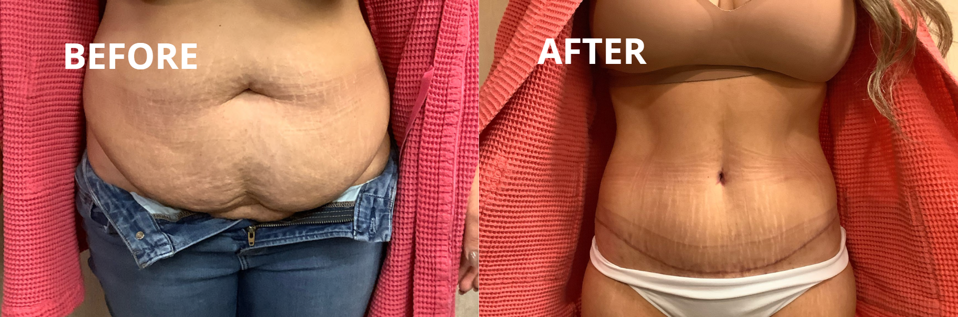 A before and after picture of a woman 's stomach.