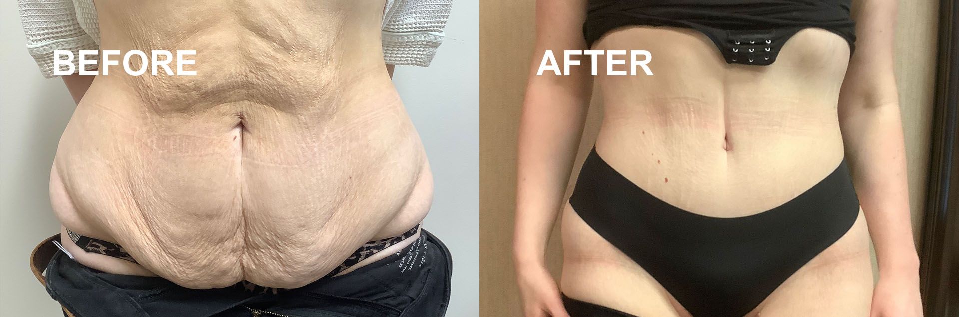 A before and after picture of a woman's stomach.