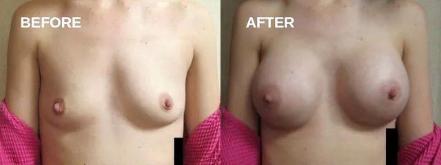 Breast augmentation