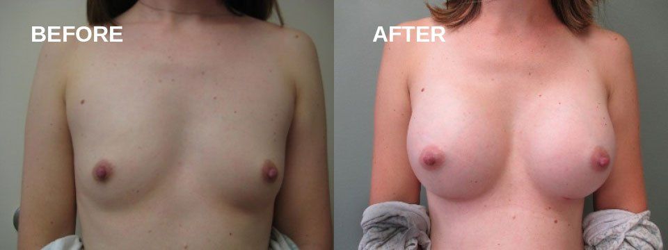 Breast augmentation