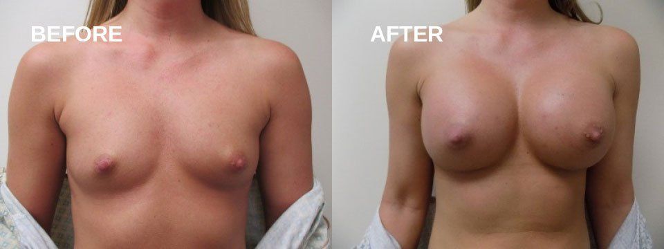 Breast augmentation