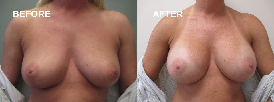 Breast augmentation