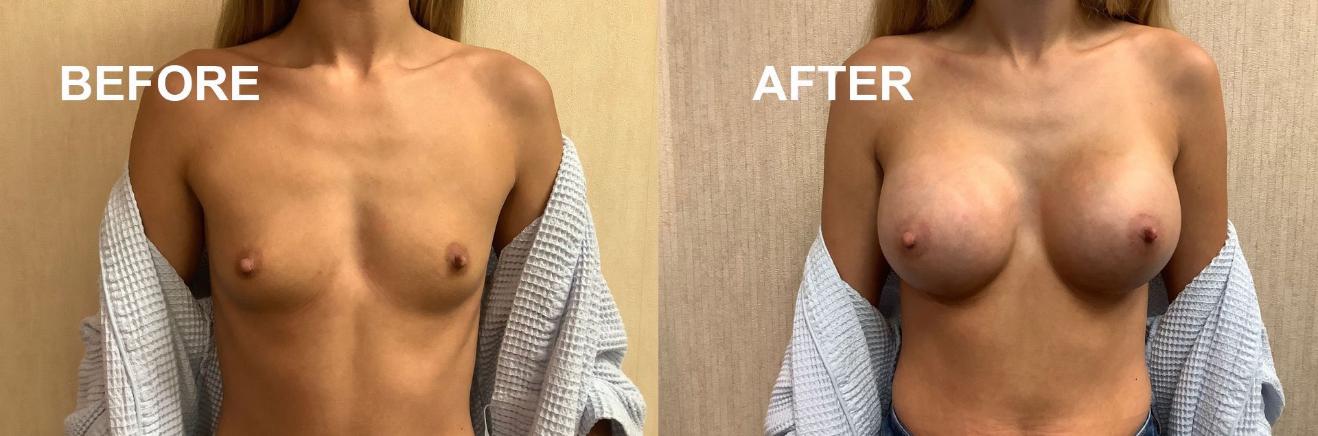 Before and after breast augmentation service