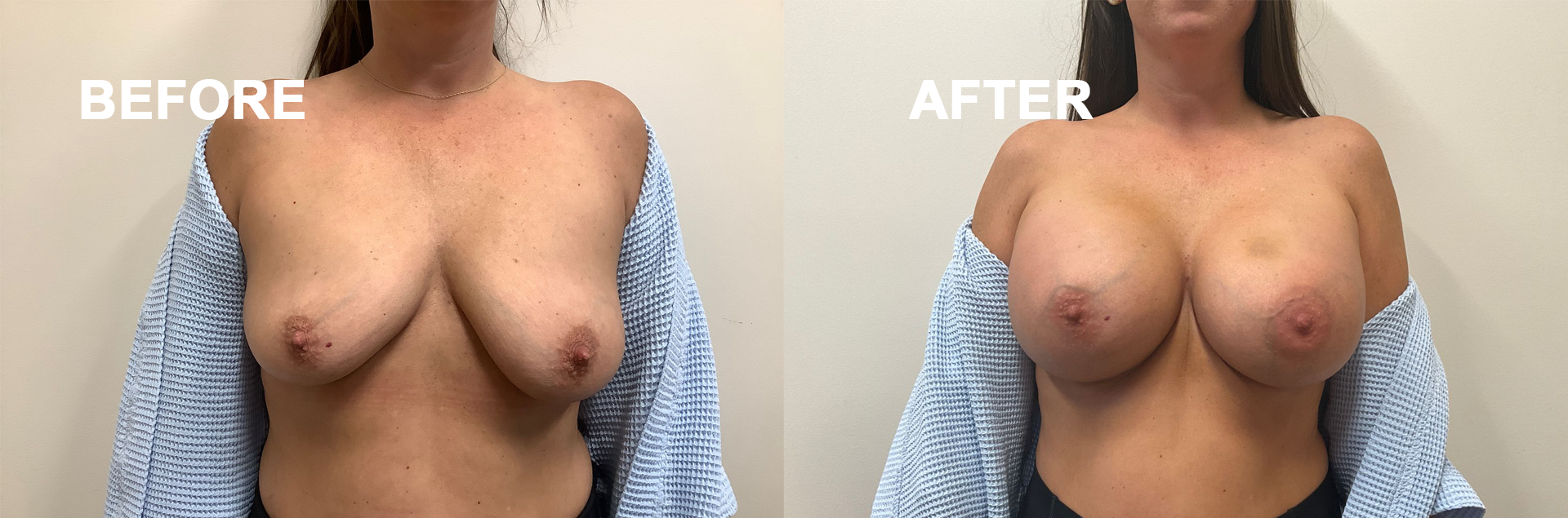 Before & After Breast Augmentation Photos