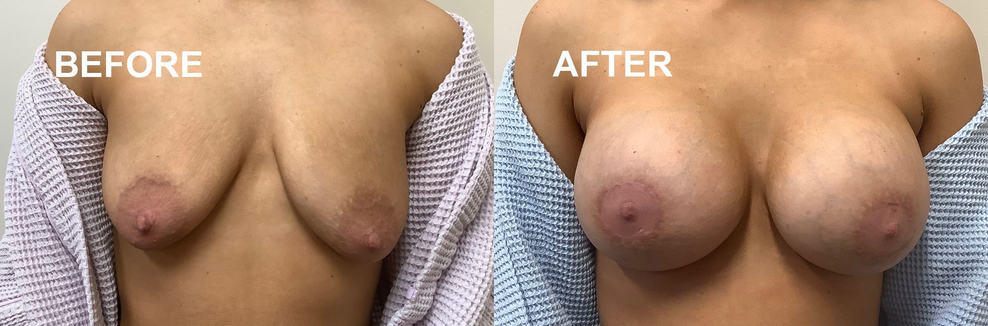 Breast augmentation