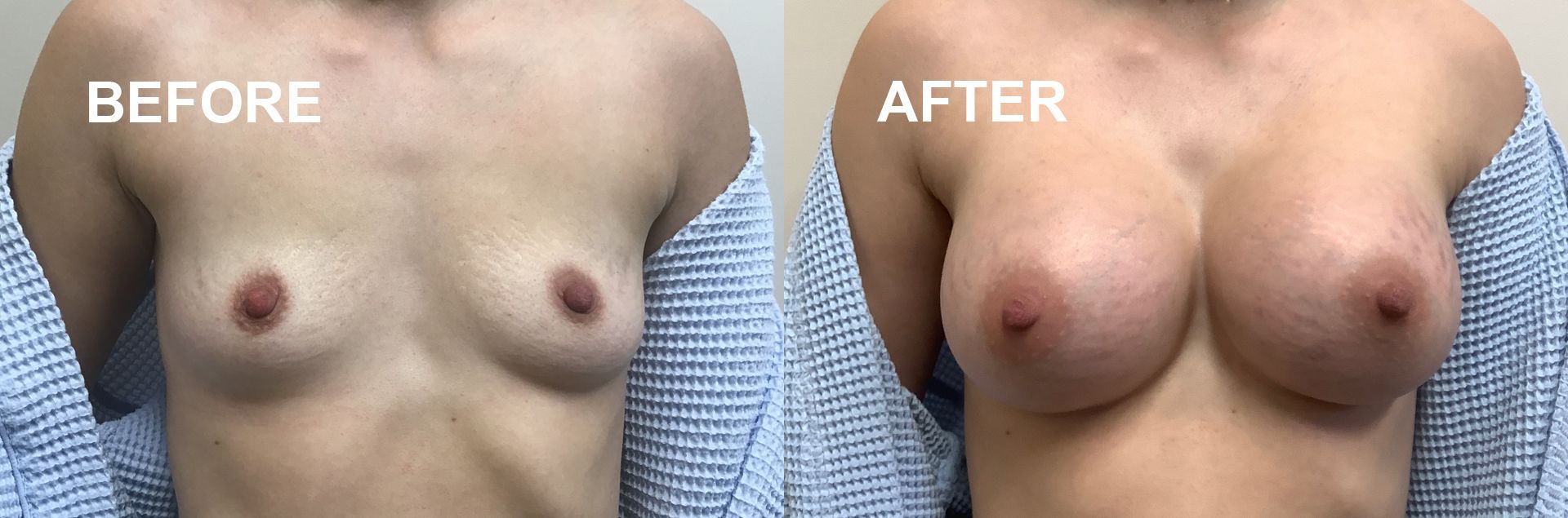 Breast augmentation