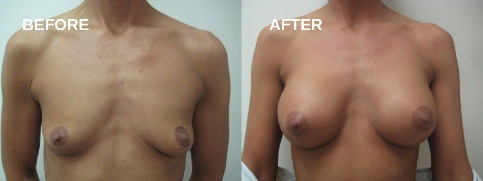 Breast augmentation