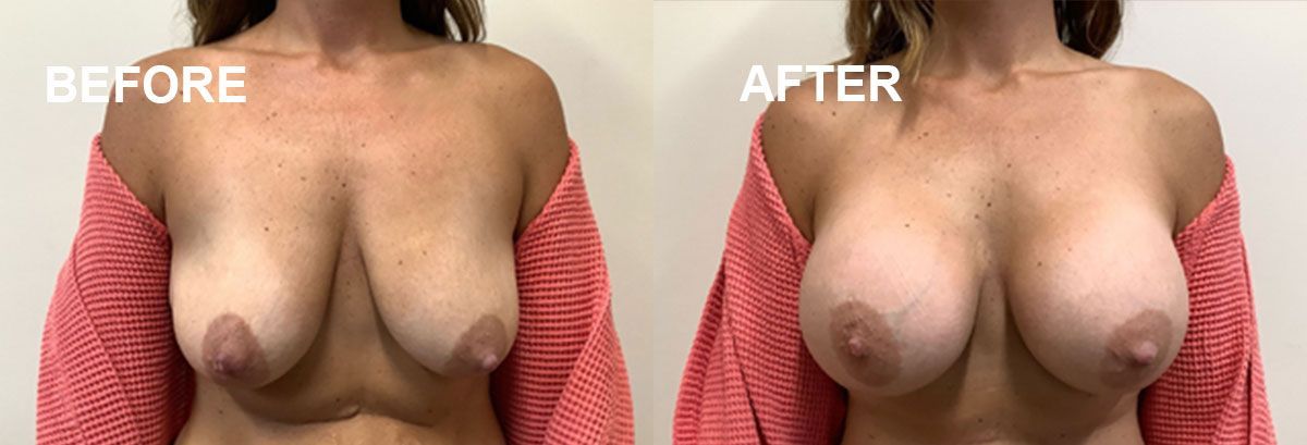 Professional breast augmentation - before and after