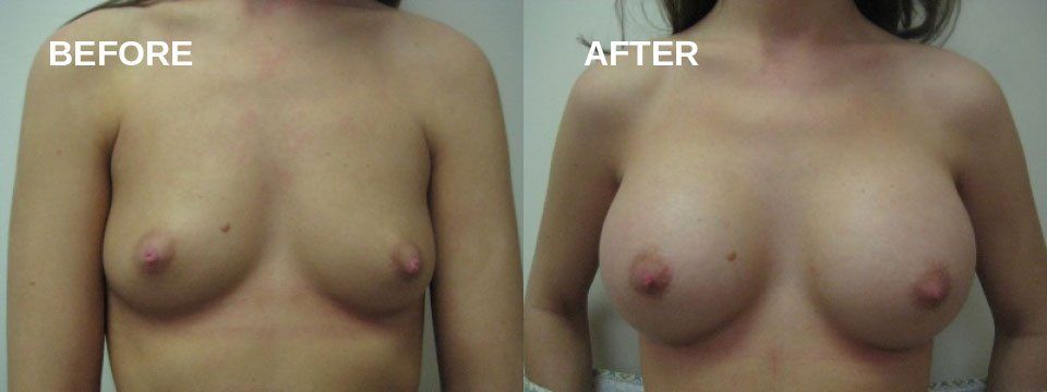 Breast augmentation