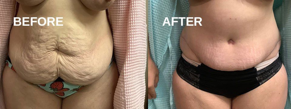 Tummy tuck